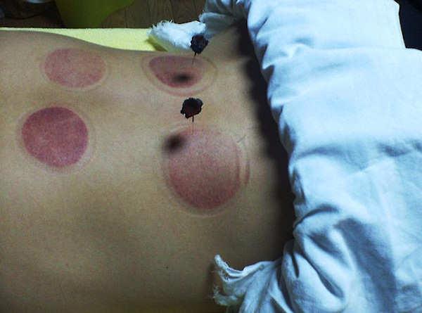 moxibustion, TCM